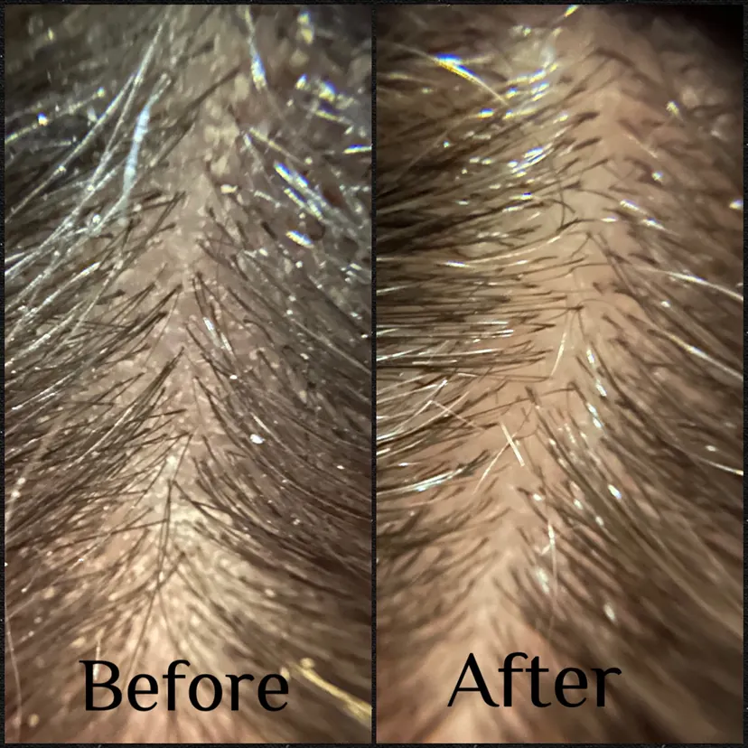 Client before and after, Clearer scalp, healthier shine after one treatment