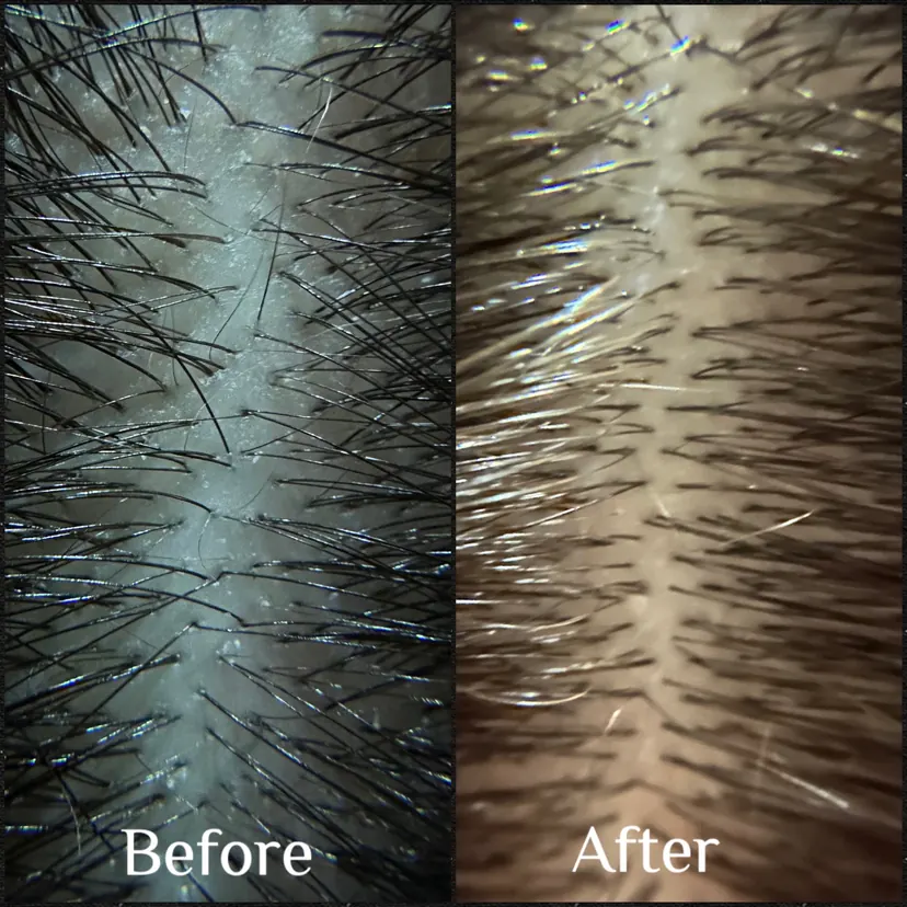 Before and after scalp treatment