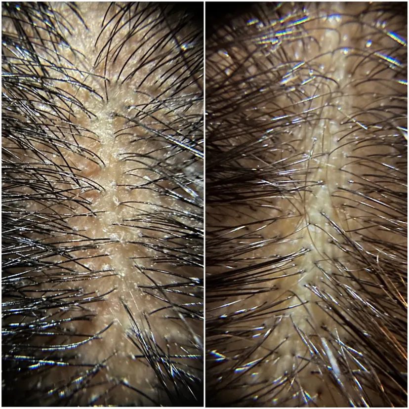 Client before and after, Lifted residue, restored scalp clarity