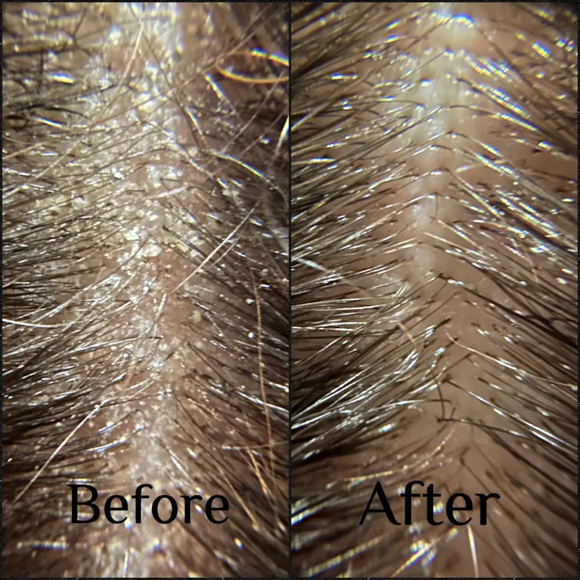 Client before and after, After 1 session, visibly reduced flaking and buildup