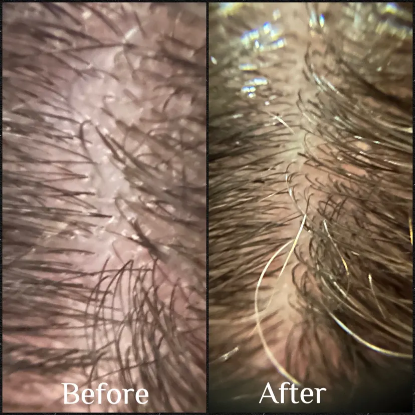 Before and after scalp treatment