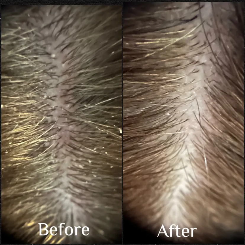 Client before and after, Calmer, balanced scalp with improved texture